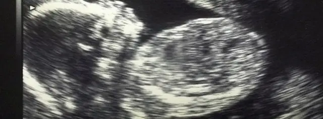 Ultrasound of baby in the womb