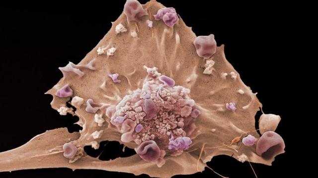 显微镜下的乳腺癌细胞