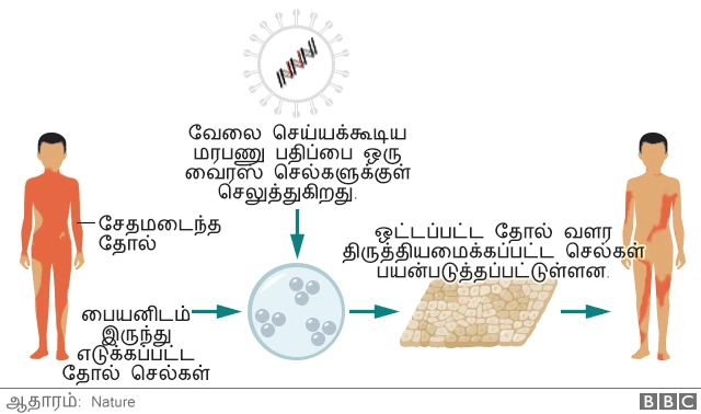 உயிர் காக்கும் தோல் வழங்கப்பட்ட "வண்ணத்துப்பூச்சி குழந்தை"