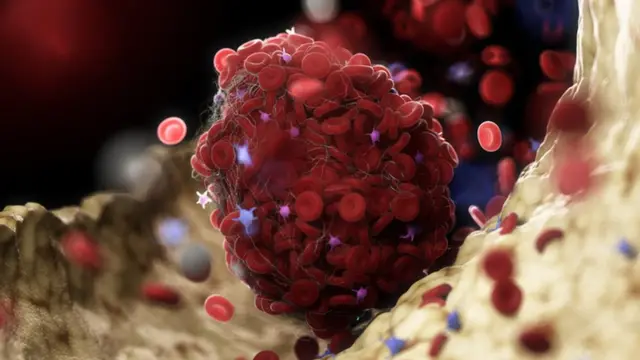 ரத்த உறைவு மாதிரிப் படம்