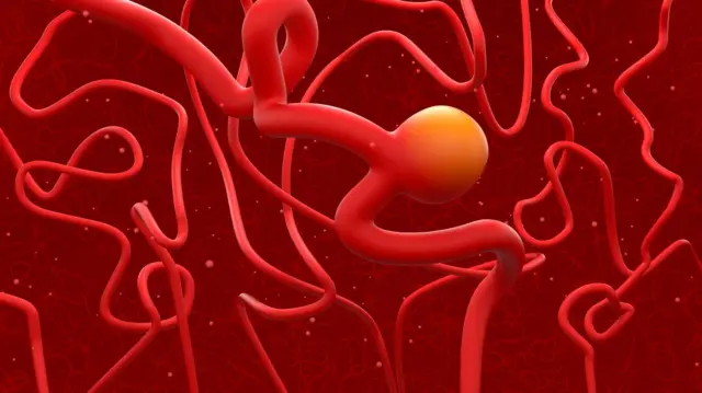 ਬ੍ਰੇਨ ਐਨਿਉਰਿਜ਼ਮ