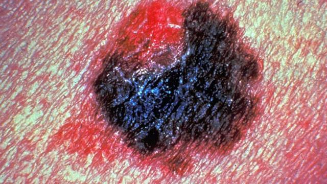 Srbija, zdravlje i melanom: „Boriš se svaki dan, želiš da ga maksimalno ...