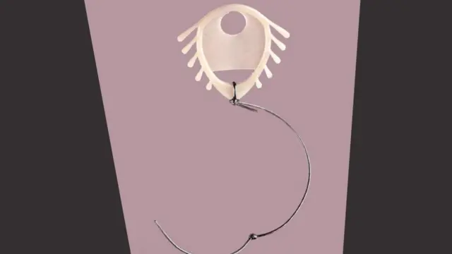 Dispositivo Dalkon Shield