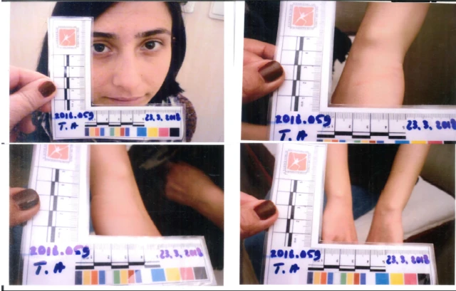 Tilbe Akan'ın epikriz raporundan