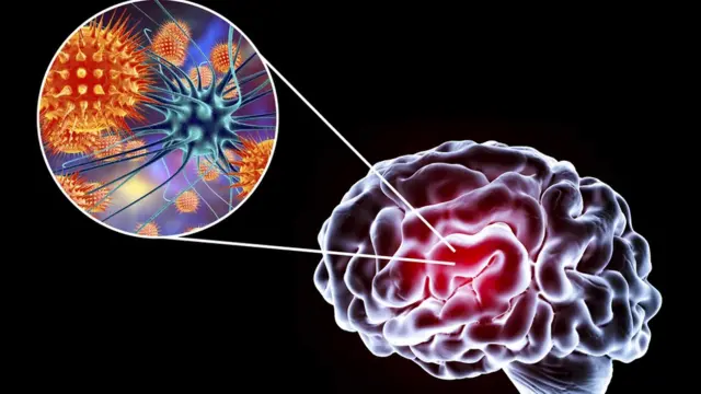 ज़ीका वायरस का मस्तिष्क पर असर