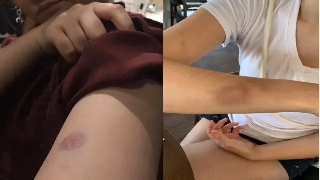 Bạn cô Warakorn (bên trái) và cô Warakorn (bên phải) bị bầm tím