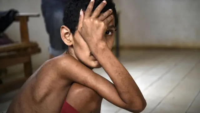 పోషకాహార లోపం