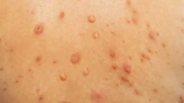 በቆዳ ላይ የሚታይ ውሃ የቋጠረ እብጠት