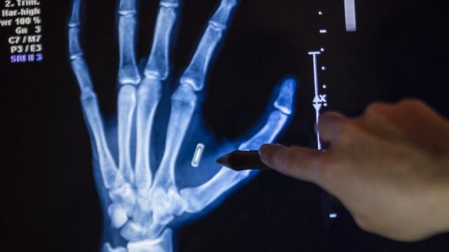 Raio-x de uma mão com um chip implantado nela