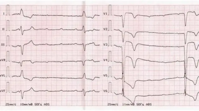 કાર્ડિઓગ્રામ