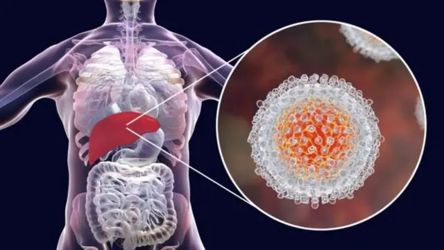 Karaciğerdeki Hepatit C virüsü