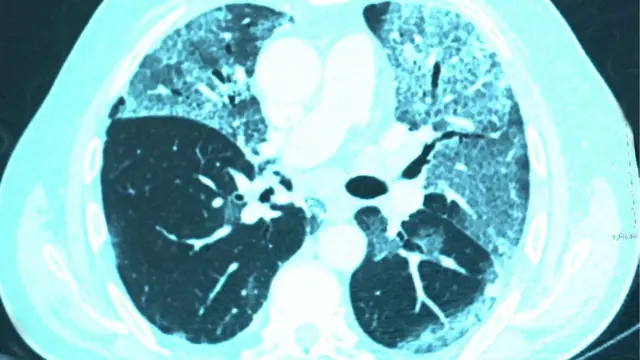 কোভিড আক্রান্ত হবার পর ক্ষতিগ্রস্ত ফুসফুসের ছবি