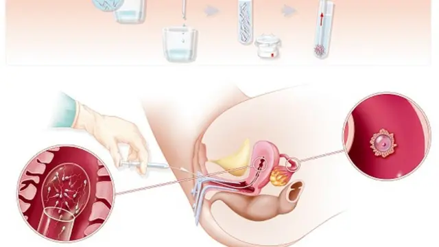 వంధ్యత్వ సమస్య
