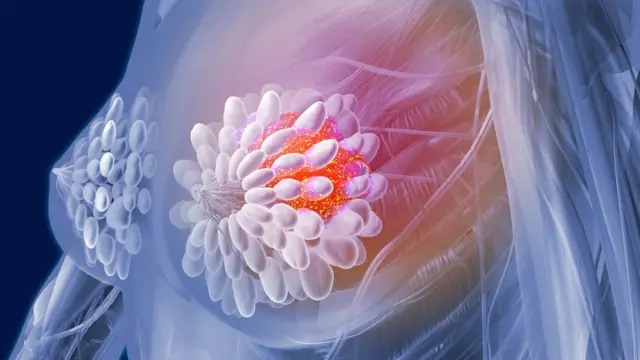 Ilustración, cáncer de pecho