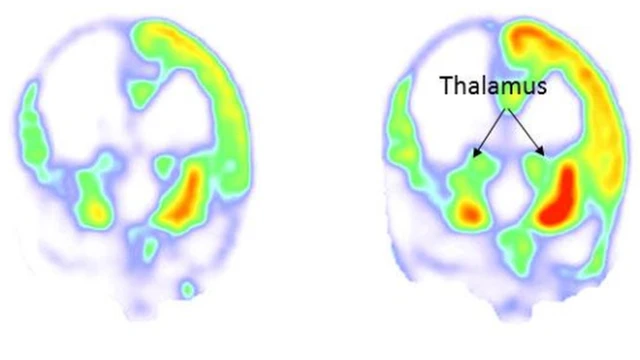 Escáneres cerebrales
