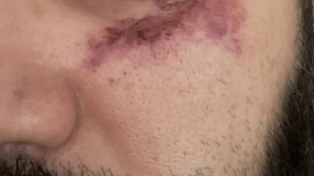 أحد المعتقلين والكدمات تظهر على وجهه