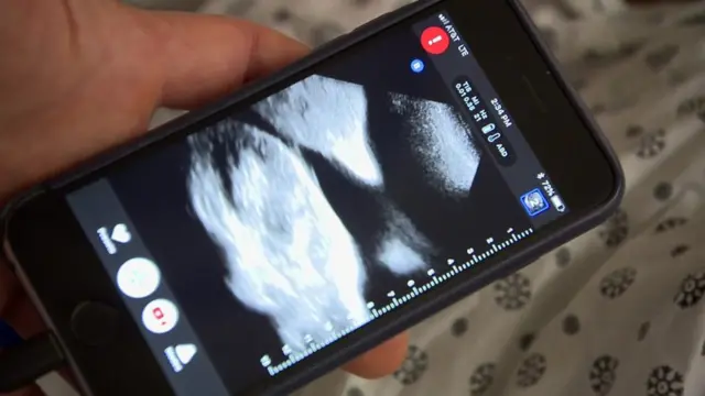 ultrasonido en un celular