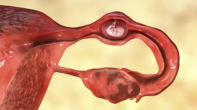 Illustration d'une grossesse extra-utérine