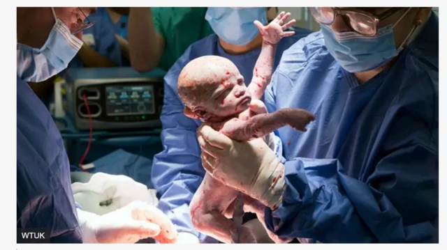 Amy, ọmọ ti wọn fi iṣẹ abẹ ile ọmọ ẹlomi-in bi.