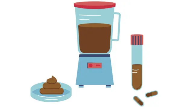 Ilustración de cómo se hace un trasplante fecal