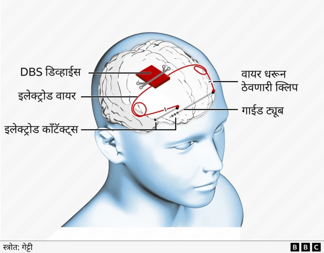 एपिलेप्सी उपकरण