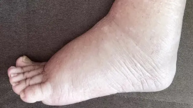 हत्तीरोग