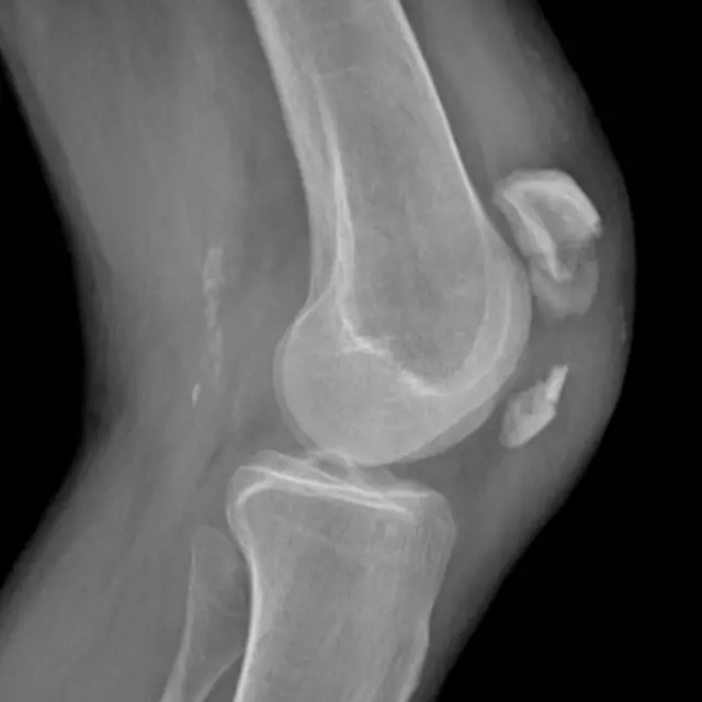 Radiografía de una rodilla