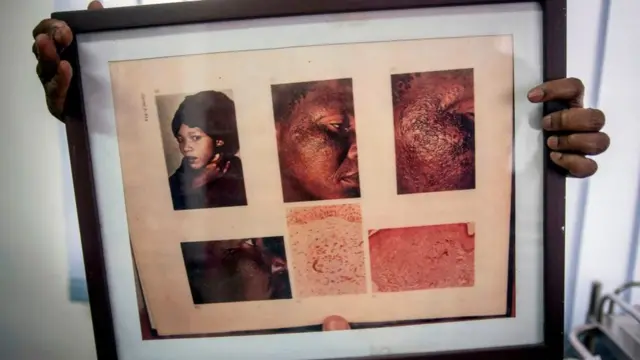 Dans ce cadre, un médecin affiche des images d'une femme souffrant d'un désordre cutané dû à une application prolongée de produits éclaircissants pour la peau à l'hydroquinone.