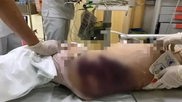 Cơ thể của bé Vân An có nhiều vết bầm tím