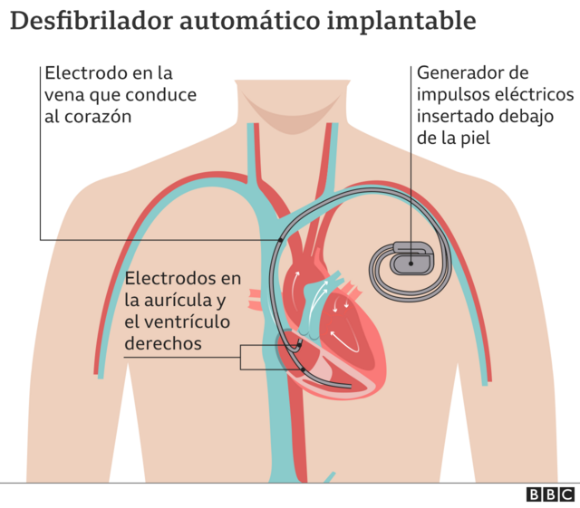 Gráfico del desfibrilador automático implantable, también llamado desfibrilador cardioversor implantable.