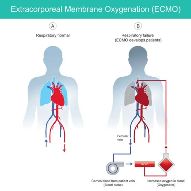 ECMO treatment patient