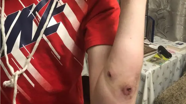 네치포렌코는 부카 시내에서 러시아 군인에 의해 팔과 손에 총상을 입었다