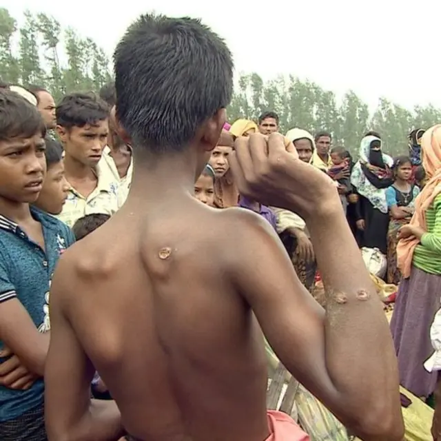 மியான்மரில் இருந்து தப்பி வந்தோர் சிலர் கொண்டிருக்கும் வடுக்கள் துப்பாக்கி குண்டுகளால் ஏற்பட்டவை என்று அவர்கள் கூறுகின்றனர்
