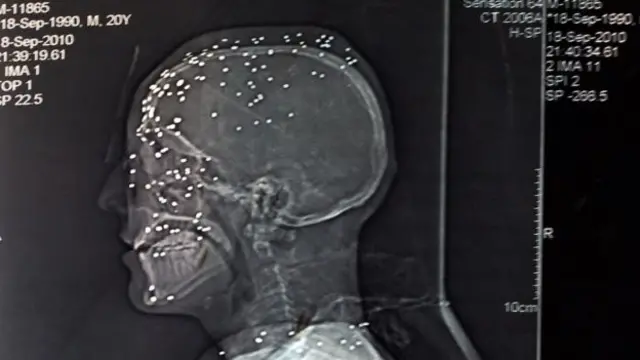 පෙලට් ප්‍රහාරයකට ලක් වූ පුද්ගලයෙකුගේ හිසේ 'එක්ස් රේ' වාර්ථාවක්