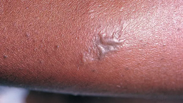 Gonorrhoea ontop pesin skin