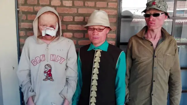 Umurwayi arabangamirwa ku mubiri wiwe cane cane iyo hatse uruzuba