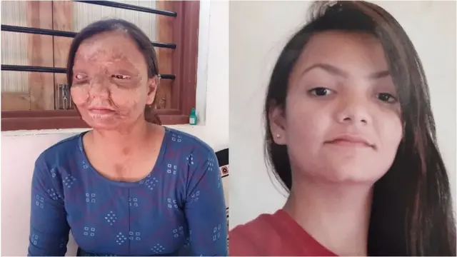 એસિડ એટેક પછી પણ ભણવાની ધગશ ધરાવતાં કાજલે ફરી અભ્યાસ શરૂ કર્યો છે