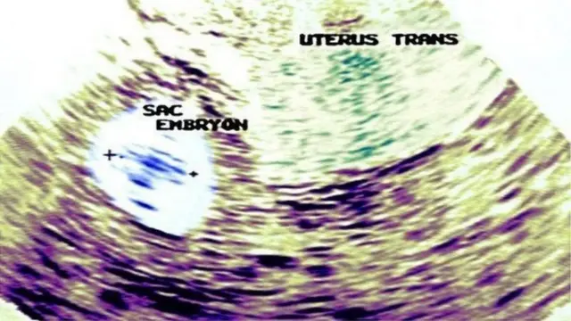 અલ્ટ્રાસાઉન્ટ