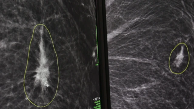 Two areas of concern circled on a mammogram by AI software