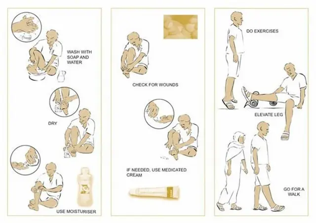 Ihe onye nwere ọrịa Elephantiasis kwesịrị ị na-eme
