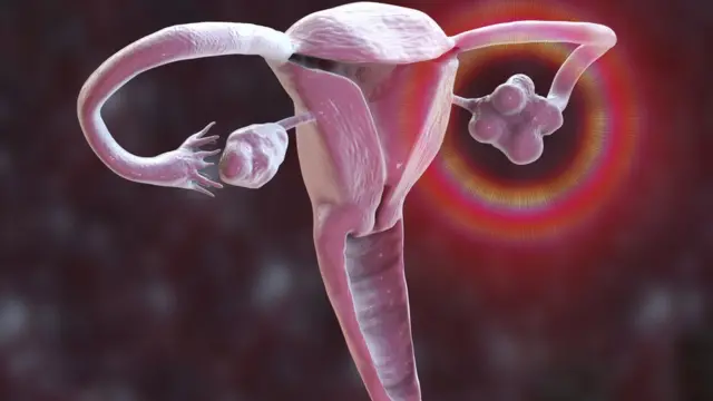 பிசிஓடி என்பது என்ன?