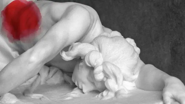 Ендометріоз