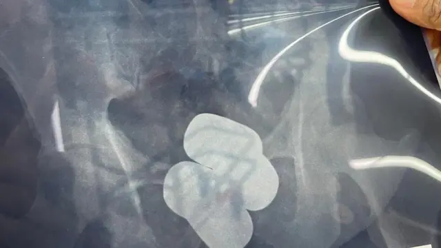 রেক্টামের এক্স রে রিপোর্টে স্বর্ণবারের ছবি