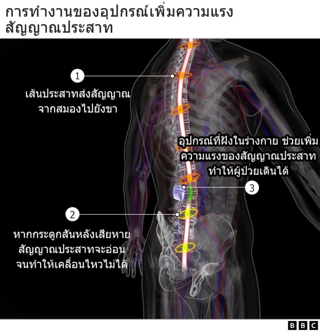 กราฟิกกระดูกสันหลัง