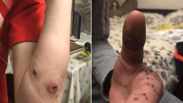 Yuriy mostra feridas que, segundo ele, foram causadas por um soldado russocasa de aposta 5 reaisBucha