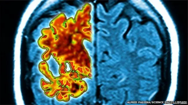 अल्झायमर