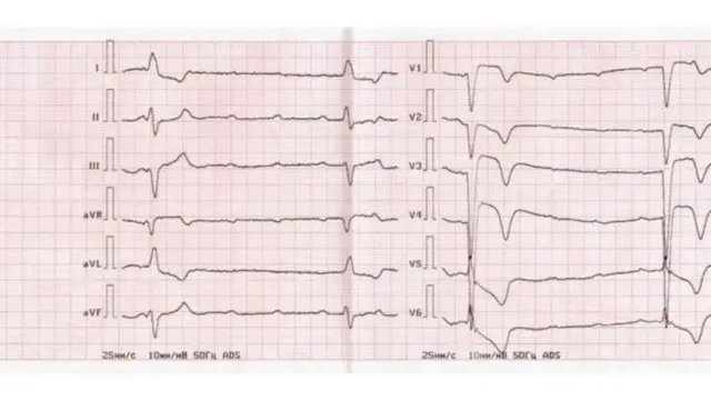 యువత, గుండెపోటు