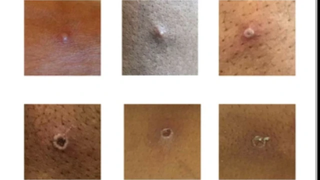 جدري القرود