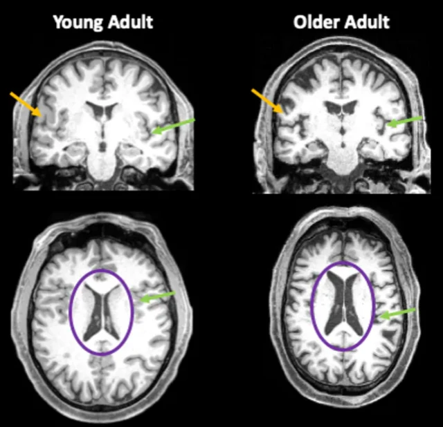 ภาพสแกนสมอง