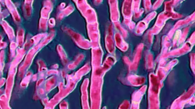 म्युकर मायकोसिस